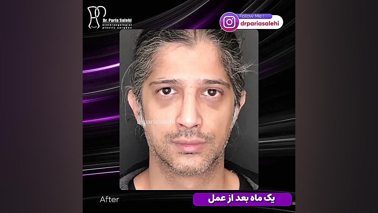 بلافاصله و یک ماه بعد از جراحی بینی دکتر پریا صالحی ✔ بهترین جراح بینی تهران