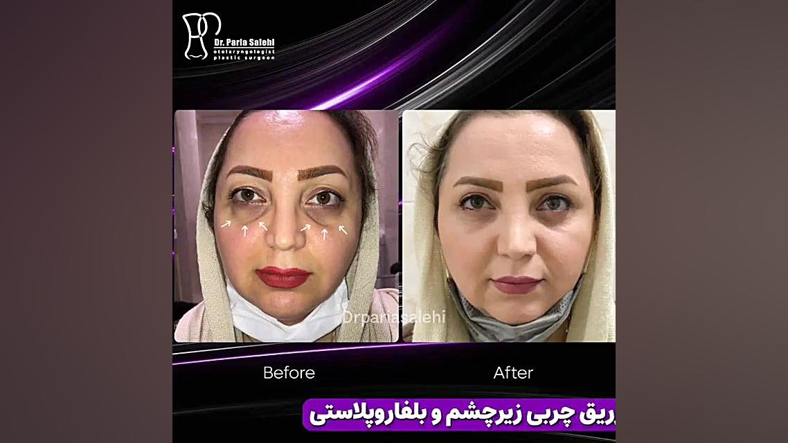 تزریق چربی زیر چشم و بلفاروپلاستی دکتر پریا صالحی ✔ بهترین جراح بینی تهران