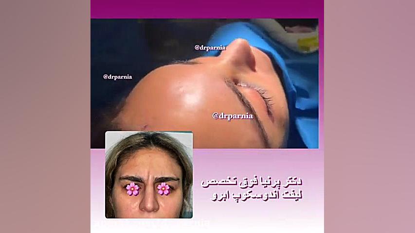 لیفت آندوسکوپی ابرو دکتر رفیع پرنیا فوق تخصص پلاستیک