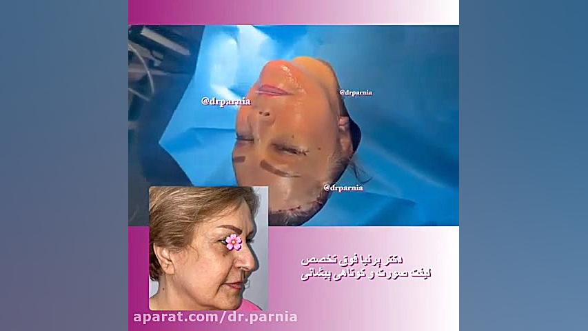 فیلم واقعی از لیفت صورت و گونه دکتر رفیع پرنیا فوق تخصص پلاستیک
