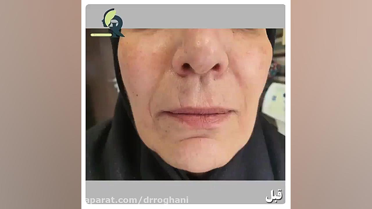 تـزریق فیلر برای بهبود چروک های اطراف دهان دکتر ایمان روغنی جراح و متخصص پوست و مو
