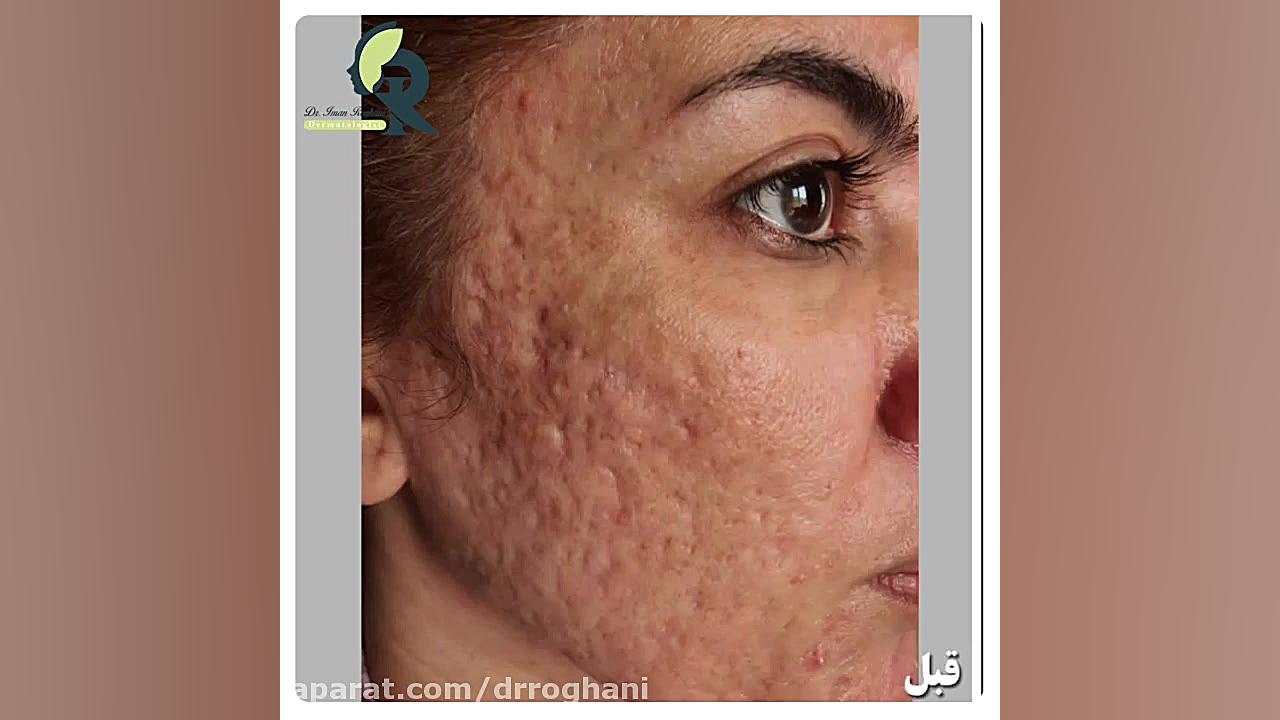 درمان ترکیبی سابسیژن لیزر و فیلر دکتر ایمان روغنی جراح و متخصص پوست و مو