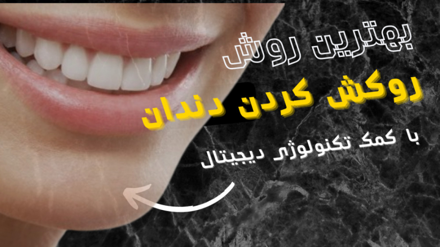 اگر روکش دندان دارید یا قراره که روکش کنید،حتما این این ویدیو رو ببینید کلینیک لیزر