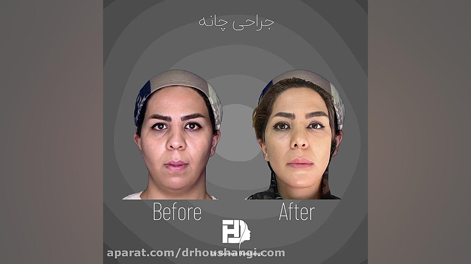 جراحی چانه - بهترین جراح فک و صورت درمان ریزش مو