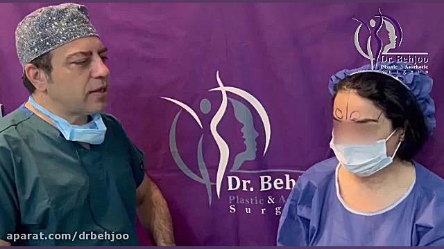 لیفت اندوسکوپیک ابرو دکتر شاهین بهجو - فوق تخصص جراحی پلاستیک