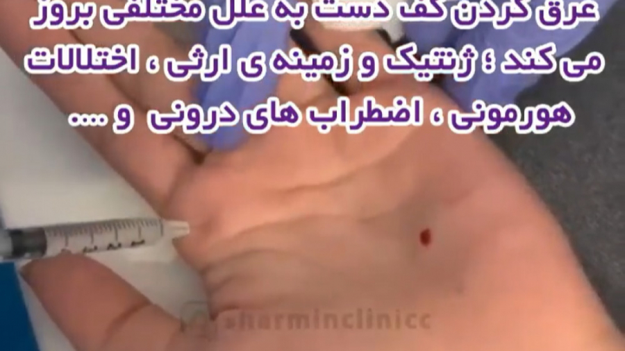 تزریق بوتاکس برای پیشگیری از تعریق دندانپزشکی کودکان