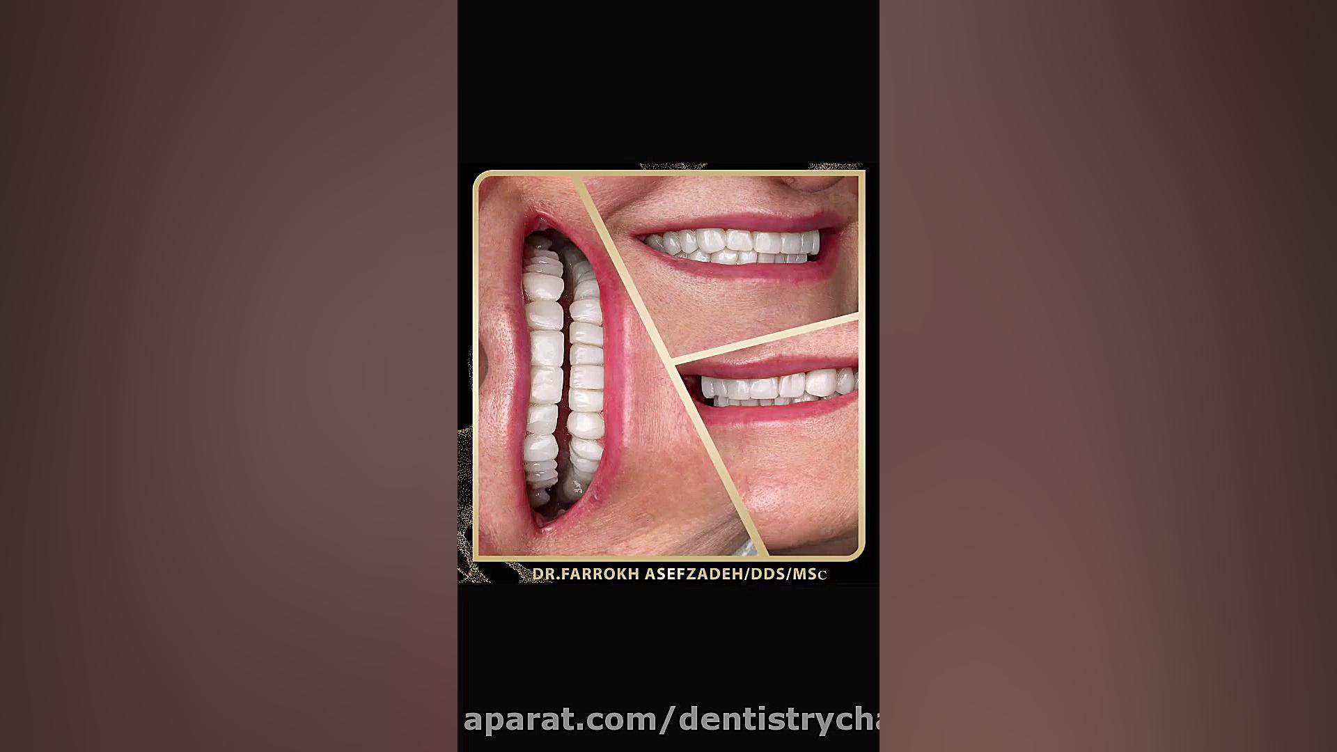 مراحل تصحیح ترمیم دندان با کامپوزیت ونیر ( دکتر آصف زاده ) ASO Test