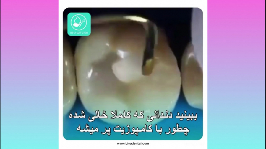 پر کردن دندان (ترمیم) در کلینیک دندانپزشکی لیا هیدروپس فتالیس