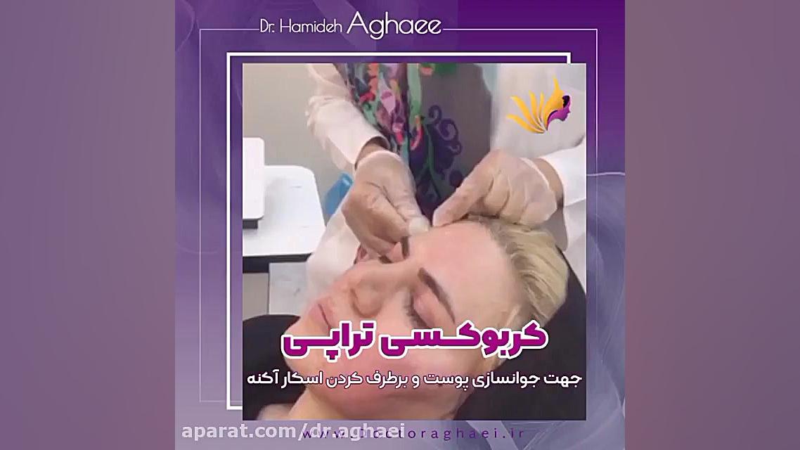 فیلم واقعی کربوکسی تراپی جهت جوانسازی پوست دکتر حمیده آقایی