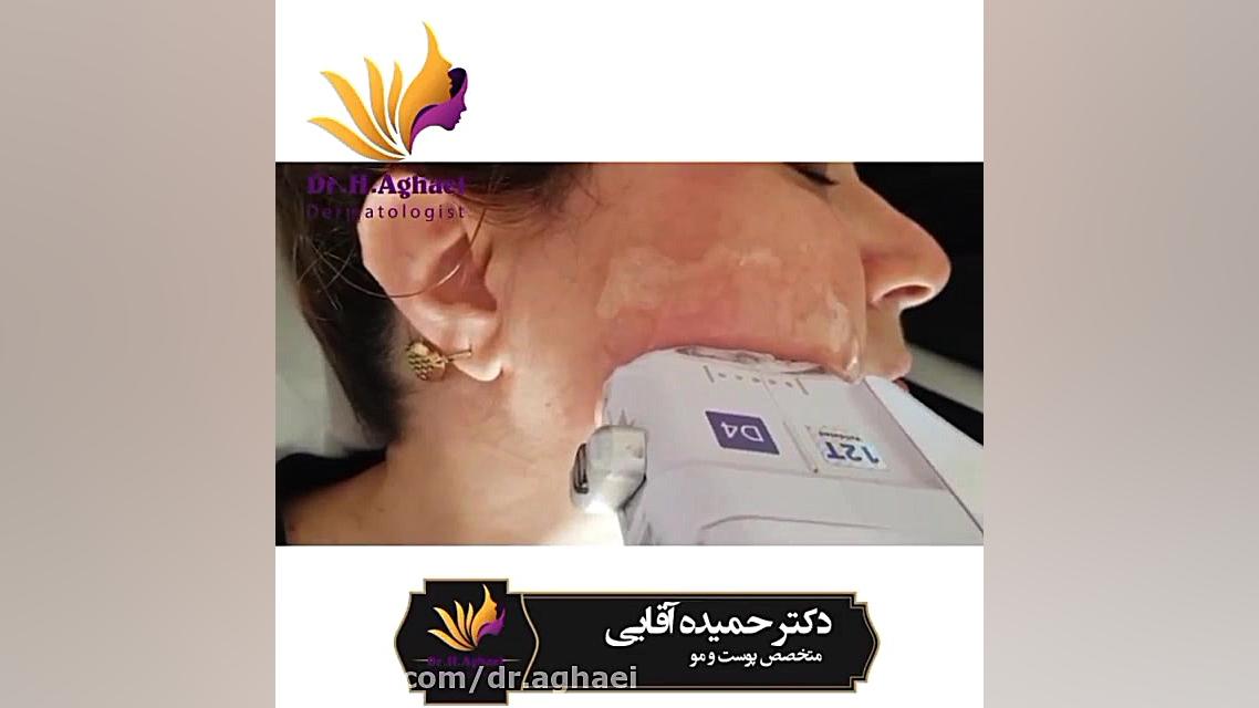 فیلم هایفوتراپی صورت دکتر حمیده آقایی