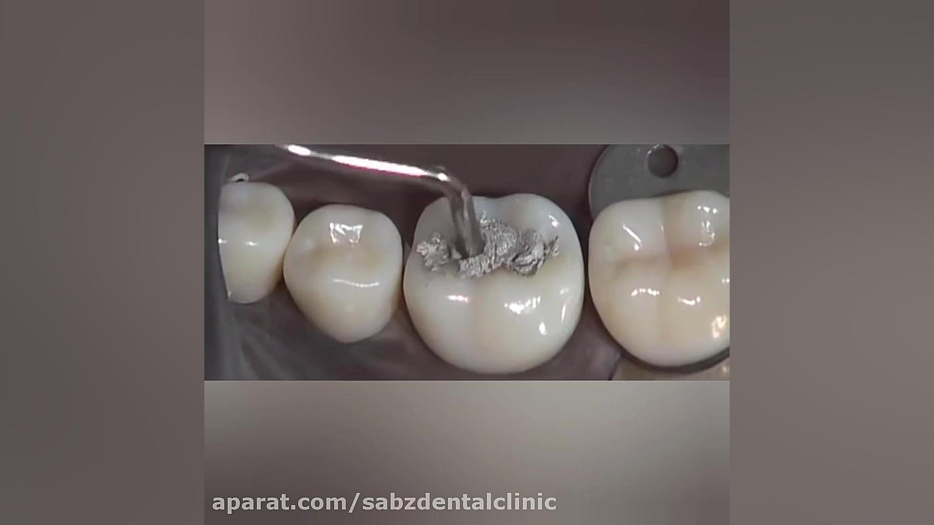 پر کردن دندان با آمالگام ماستوسیتوز