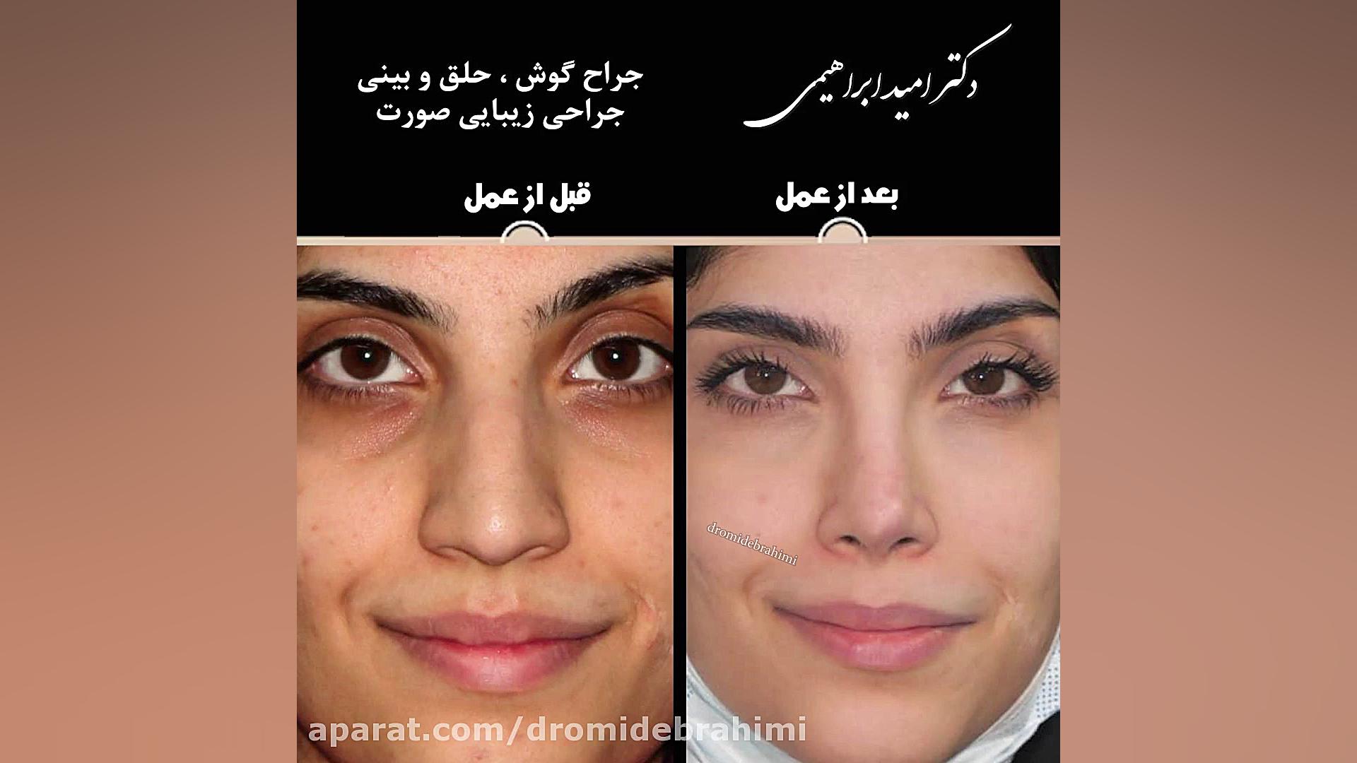 عمل زیبایی بینی توسط دکتر امید ابراهیمی بهترین جراح بینی در تهران دکتر امید ابراهیمی
