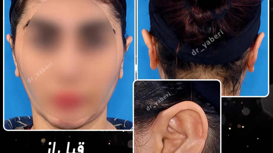 جراحی زیبایی گوش پر کردن دندان
