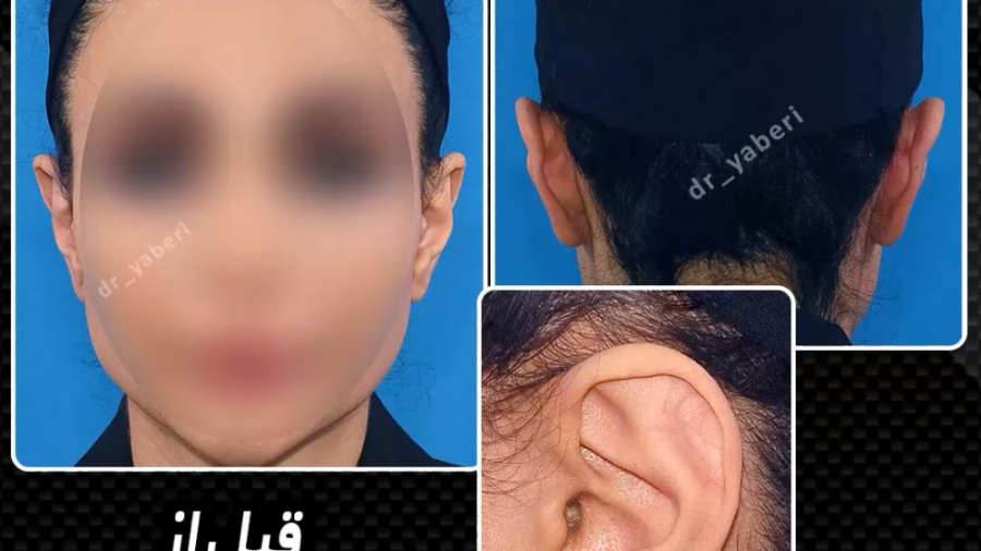 جراحی زیبایی گوش تزریق چربی