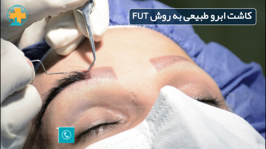 کاشت ابرو به روش FUT پلی‌مایالژیا روماتیکا