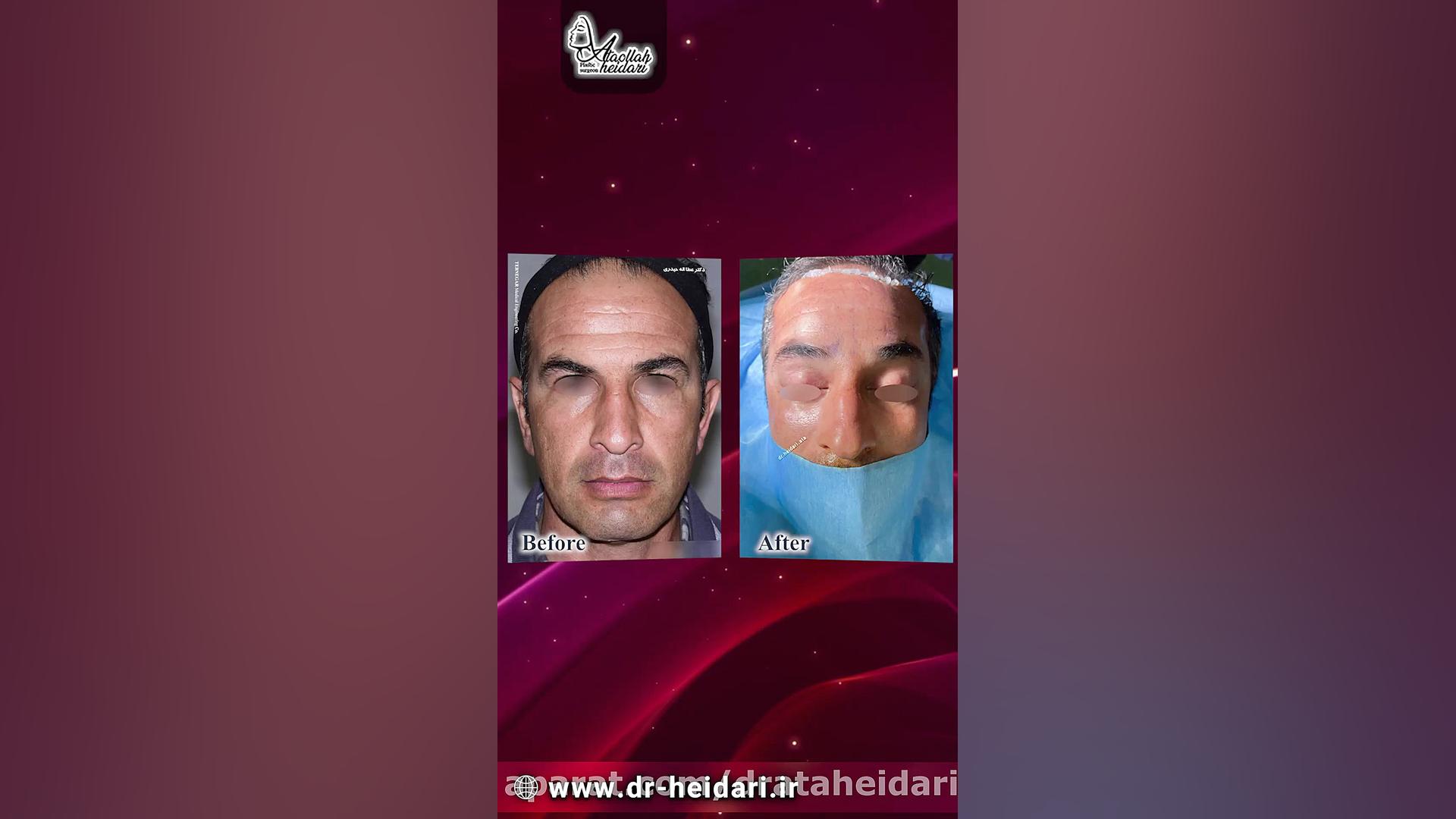 لیفت پیشانی ، ابرو و شقیقه آوتوپلیسوماب