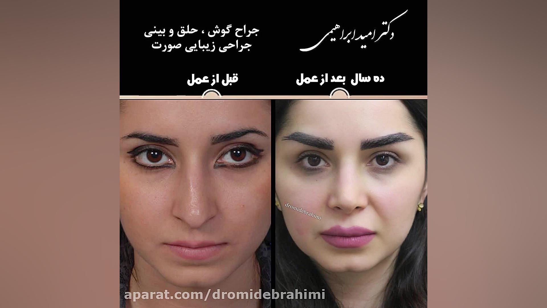 جراحی طبیعی بینی زنانه توسط دکتر امید ابراهیمی بهترین جراح بینی در تهران دکتر امید ابراهیمی