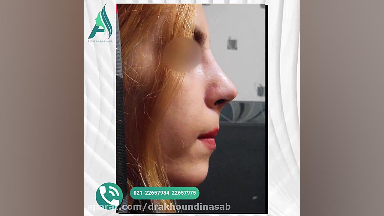 جراحی همزمان بینی و چانه دکتر محمدرضا آخوندی نسب-فوق تخصص جراحی پلاستیک