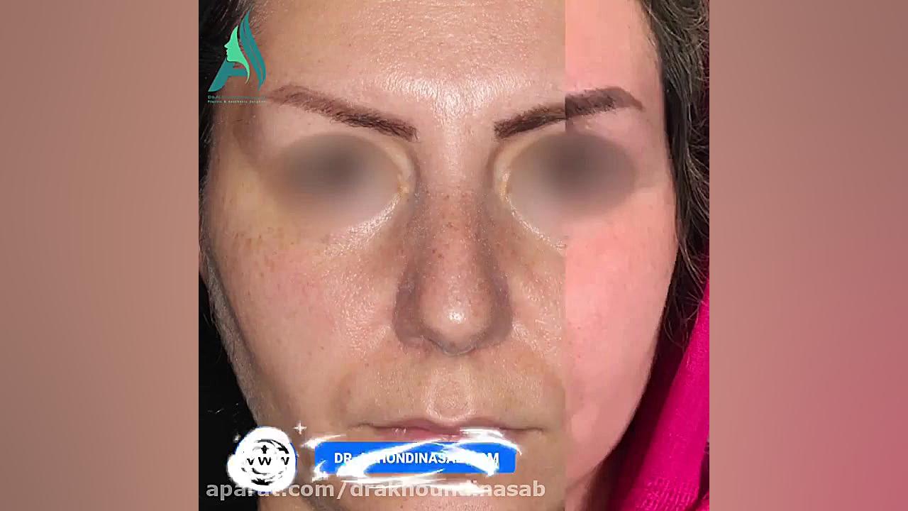 جراحی زیبایی بینی دکتر محمدرضا آخوندی نسب-فوق تخصص جراحی پلاستیک