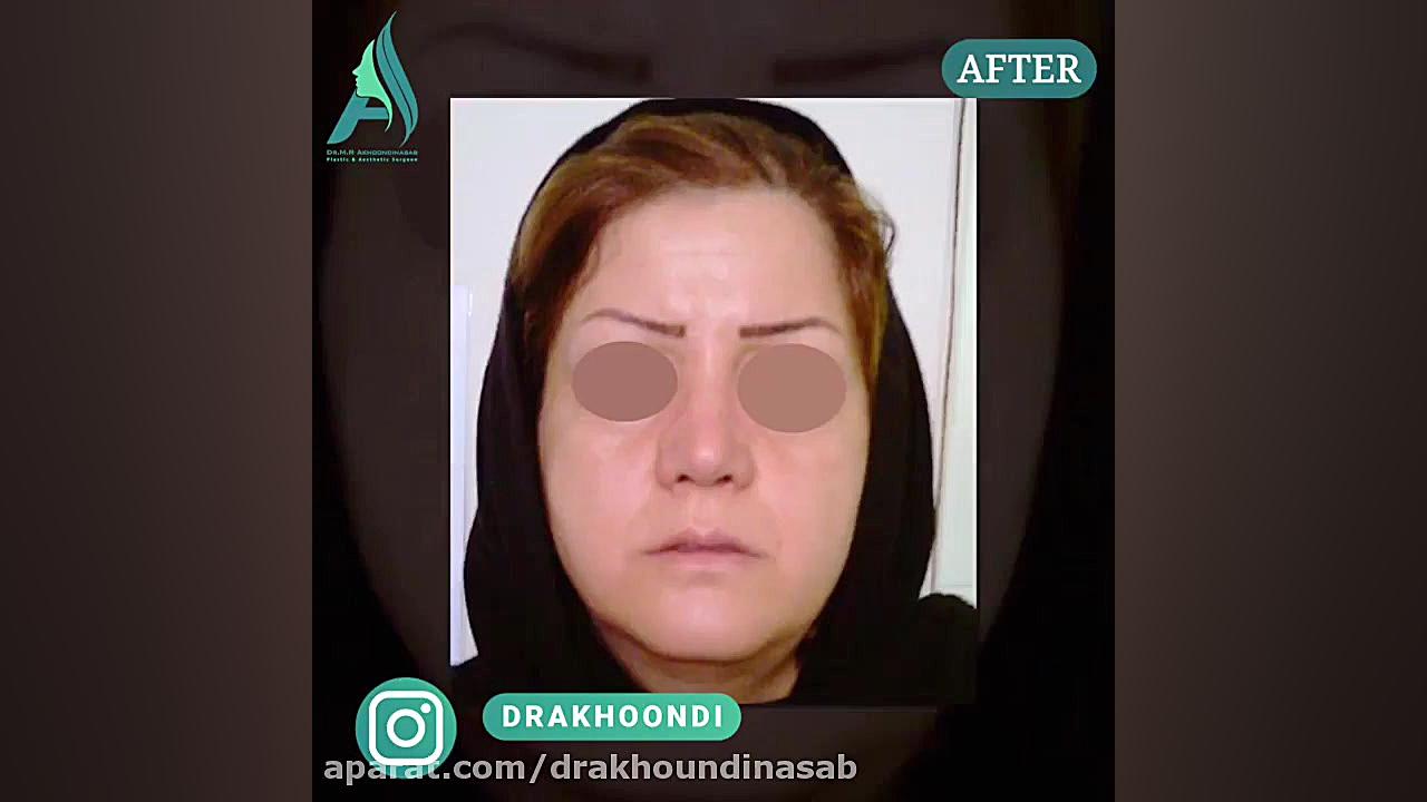 جراحی زیبایی بینی به صورت طبیعی دکتر محمدرضا آخوندی نسب-فوق تخصص جراحی پلاستیک