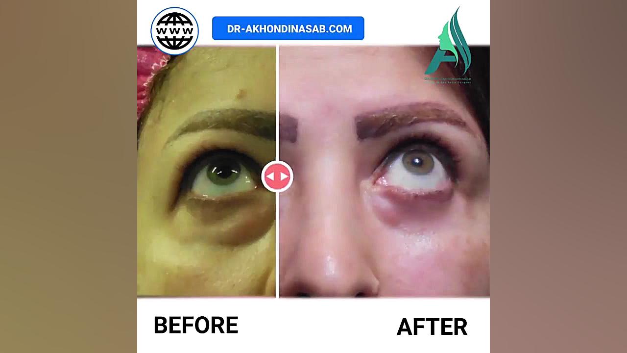 جراحی پلک پایین دکتر محمدرضا آخوندی نسب-فوق تخصص جراحی پلاستیک