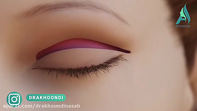 انیمیشن بلفاروپلاستی جراحی زیبایی پلک دکتر محمدرضا آخوندی نسب-فوق تخصص جراحی پلاستیک