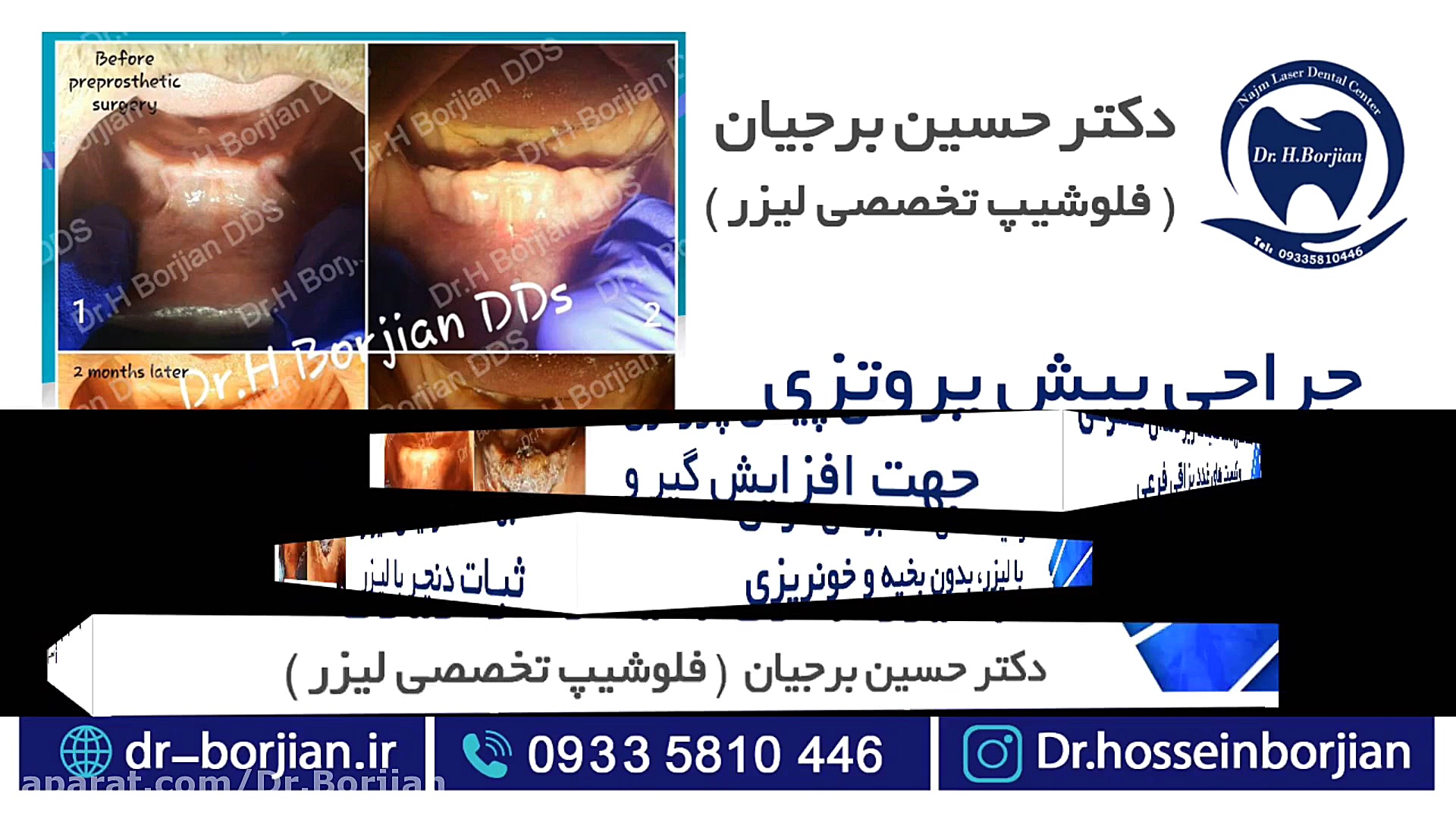 بخش ششم خدمات : جراحی های بدون بخیه و خونریزی دهان|بهترین جراح لثه اصفهان پزشکی ویرایش ژن