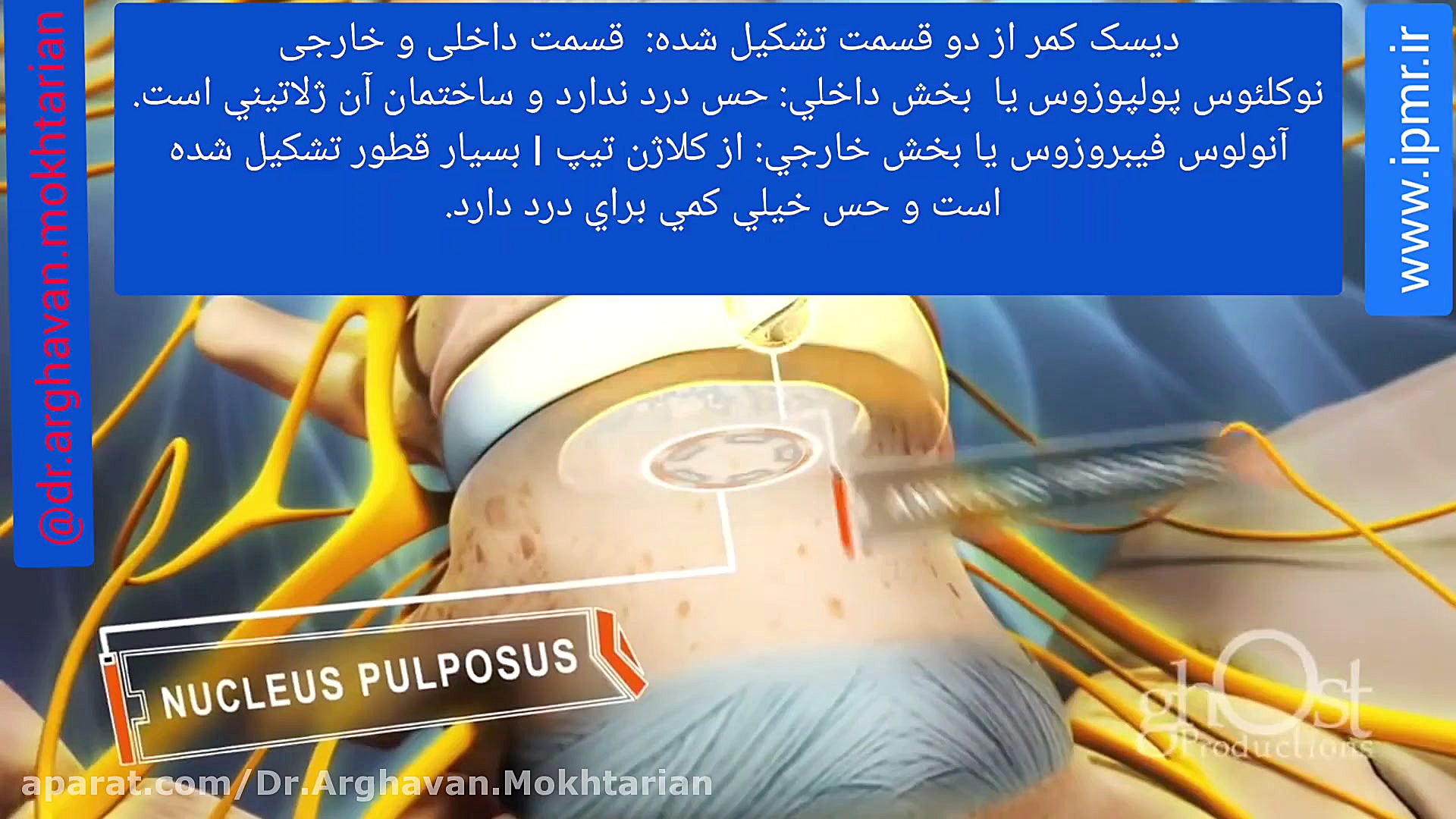 فتق دیسک کمر (بیرون زدگی دیسک) دکتر ارغوان مختاریان