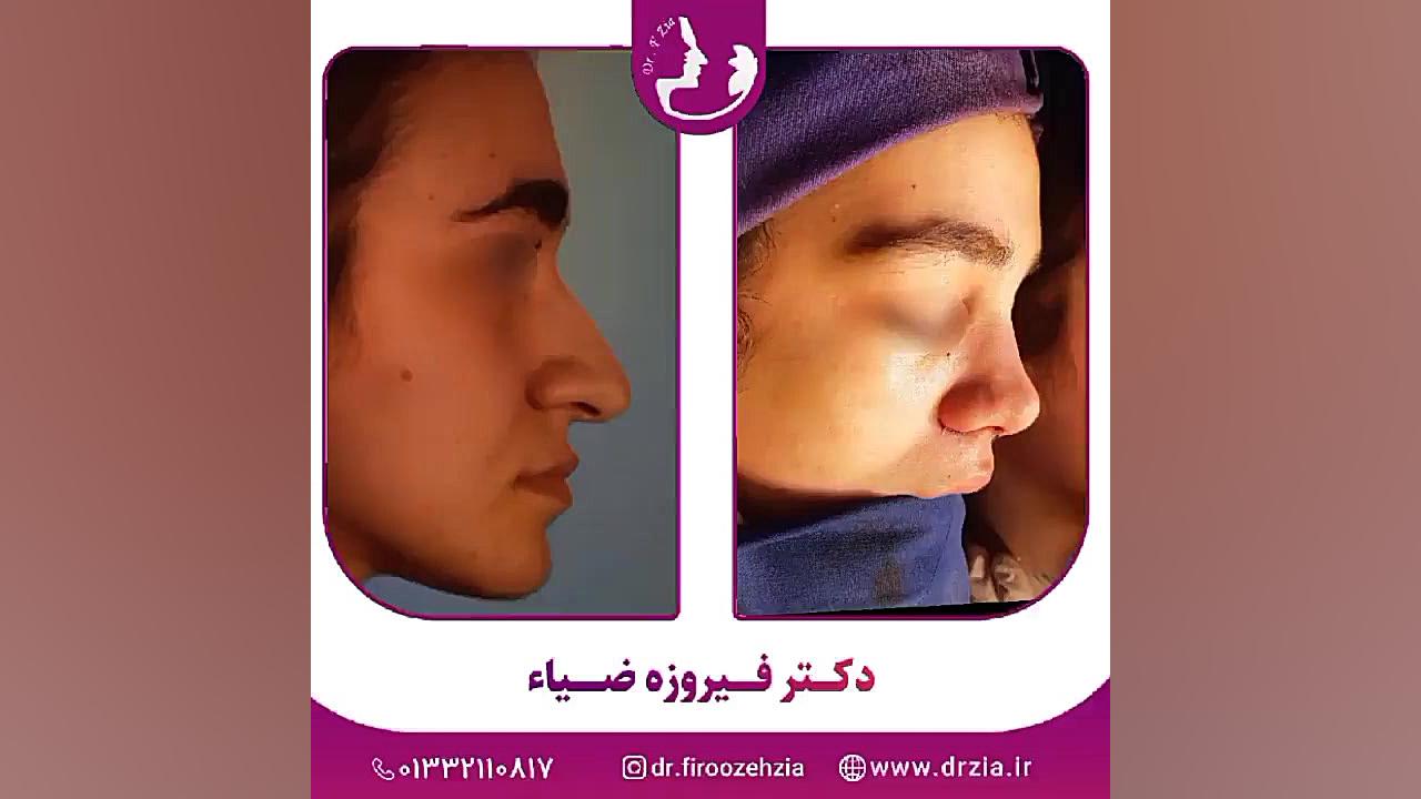 قبل و بلافاصله پس از جراحی بینی توسط دکتر فیروزه ضیاء متخصص گوش و حلق و بینی برداشتن زگیل