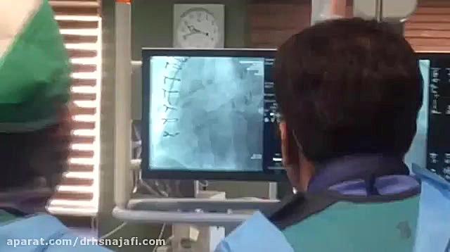 آنژیوگرافی از طریق کشاله ران برداشتن خال گوشتی