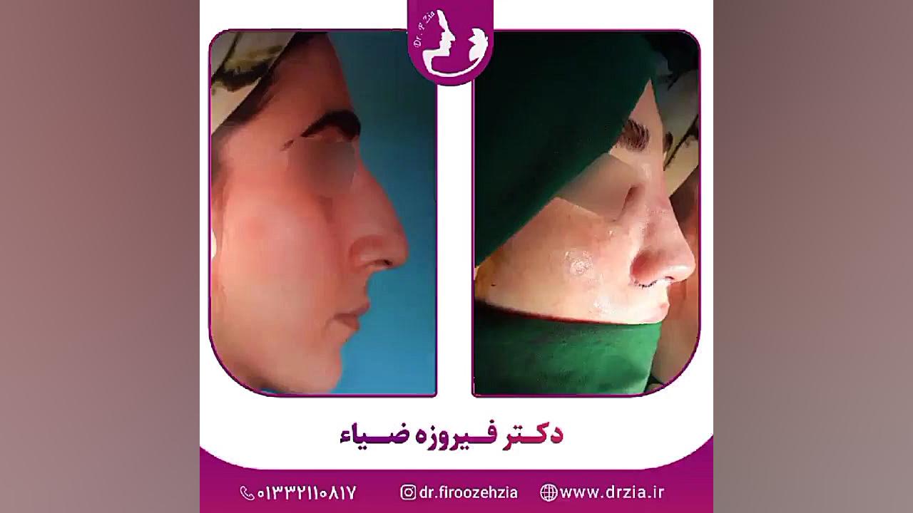 قبل و بلافاصله پس از جراحی بینی توسط دکتر فیروزه ضیاء متخصص گوش و حلق و بینی دکتر پوست