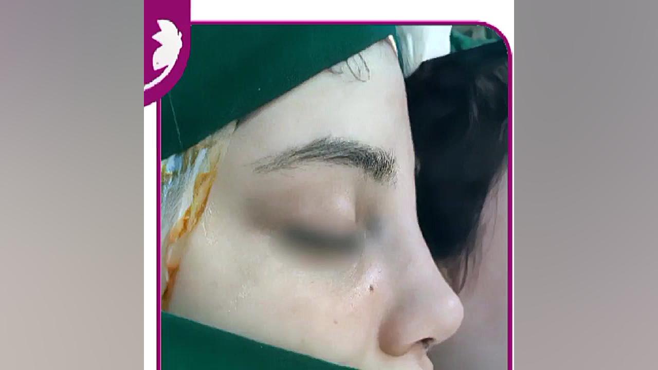 قبل و بلافاصله پس از جراحی بینی توسط دکتر فیروزه ضیاء متخصص گوش و حلق و بینی عصب‌کشی