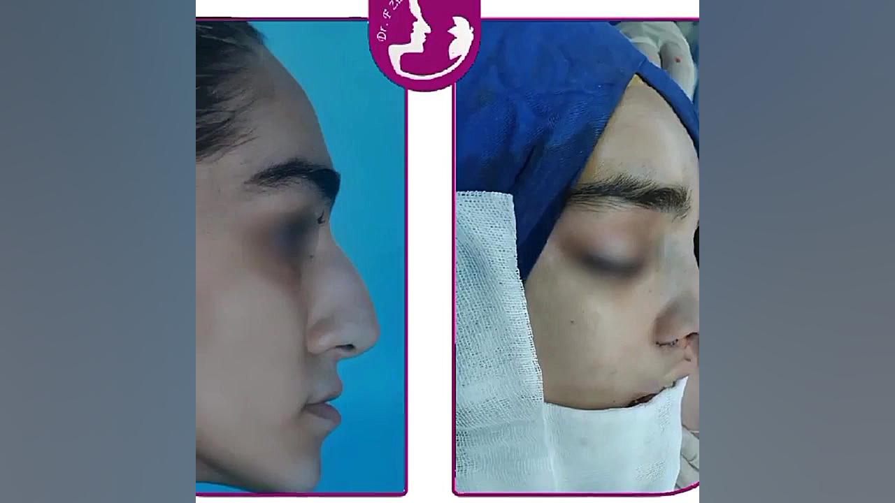 قبل و بلافاصله پس از جراحی بینی توسط دکتر فیروزه ضیاء متخصص گوش و حلق و بینی ترمیم لبخند لثه‌ای
