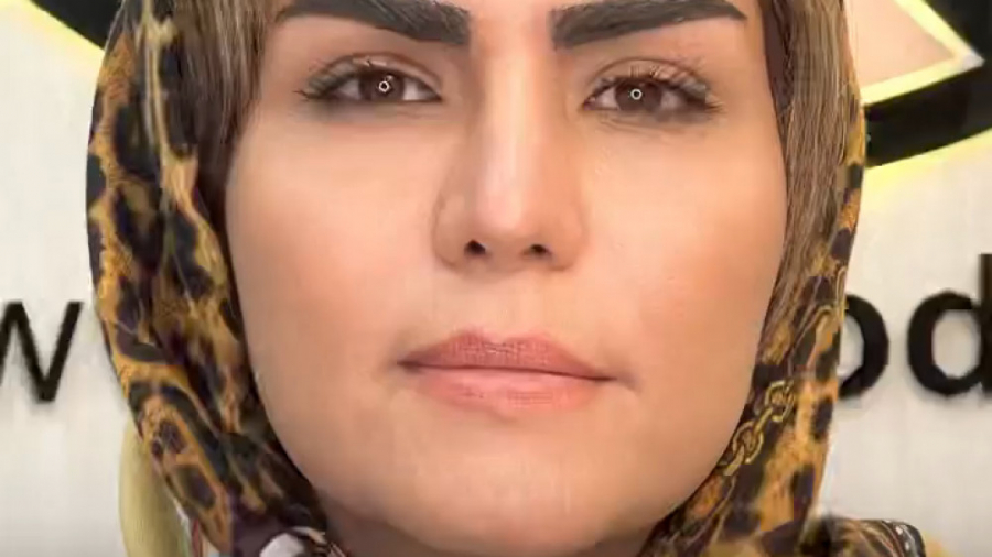 2 سال بعد از کاشت ابرو در مرکز کاشت موی کرج درمان مهاری پیوندی