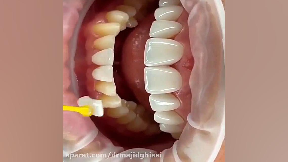 لمینت سرامیکی دندان دکترمجیدقیاسی