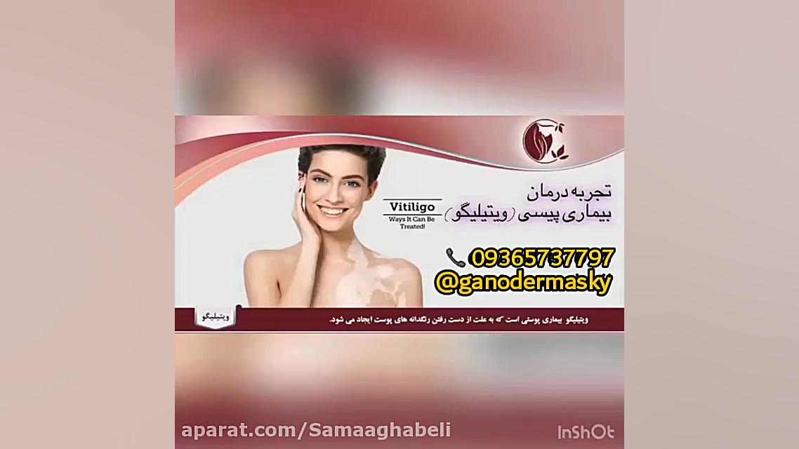 درمان جدید ویتیلیگو( پیسی_برص) چای خور چای