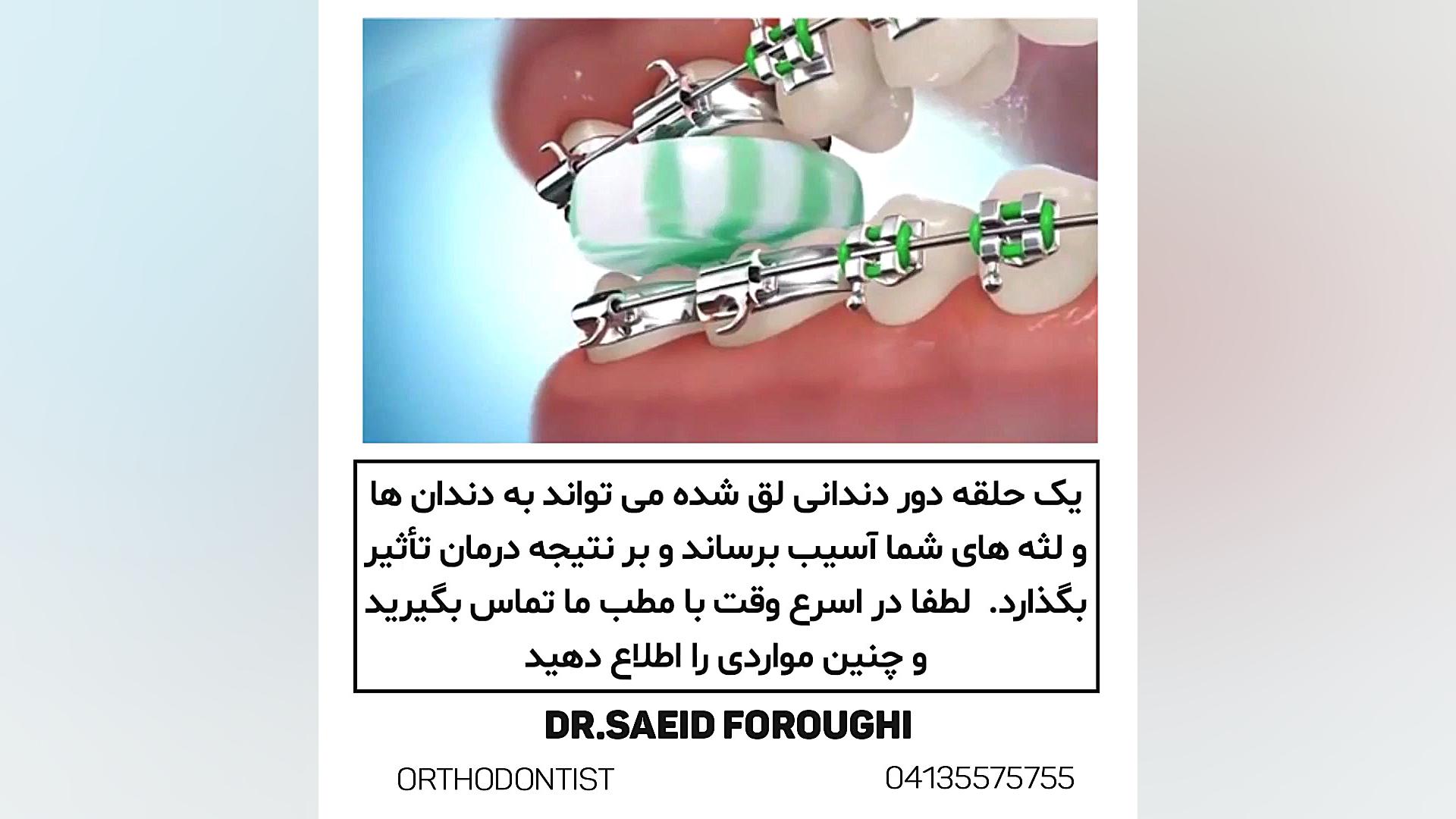 حلقه دور دندانی شل دکتر سعید فروغی متخصص ارتودنسی