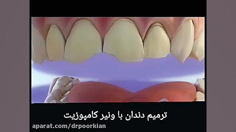 ویدیو ترمیم دندان با ونیر کامپوزیت (قسمت اول) بررسی لک صورت