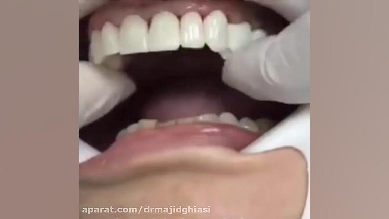 نحوه اتصال روکش به دندان دکترمجیدقیاسی