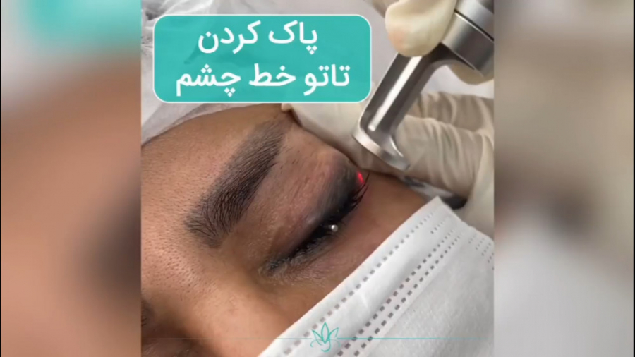 پاک کردن تاتو چشم با لیزر در کلینیک شادی TAVI