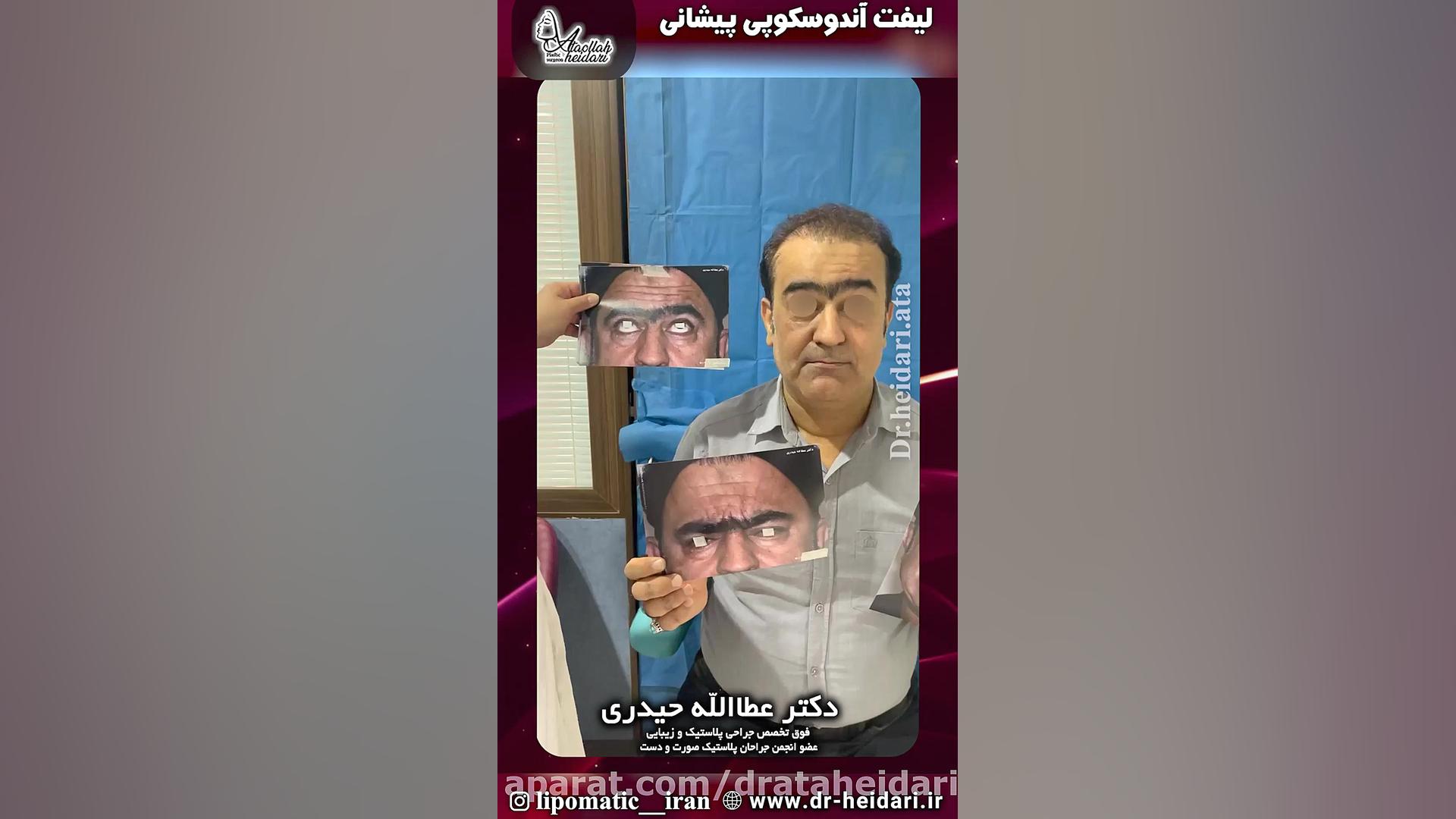 لیفت آندوسکوپی پیشانی هایپررفلکسی