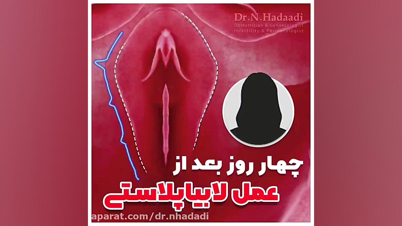 تجربه لابیاپلاستی - 4 روز بعد از عمل جراحی گوش