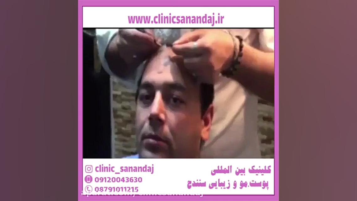 نحوه شستن موها و شامپو مناسب بعد از کاشت مو گلابی زرین