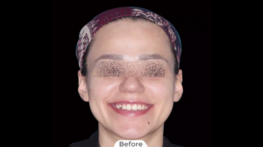 انجام ارتودنسی با کشیدن دندان نیش شیری دکتر برهمن سبزواری - متخصص ارتودنسی - مشهد