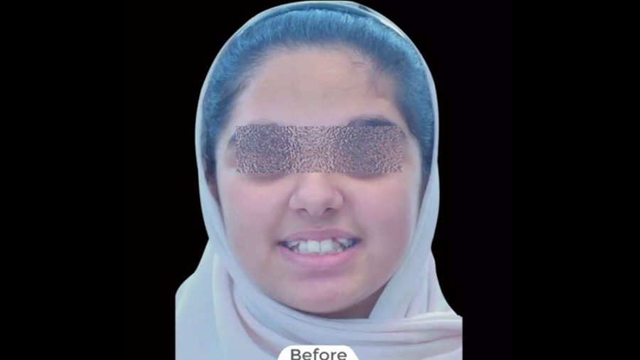 ارتودنسی ثابت فک بالا و پایین با کشیدن 4 دندان آسیای کوچک دکتر برهمن سبزواری - متخصص ارتودنسی - مشهد