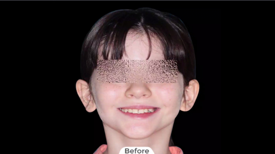 ارتودنسی ثابت فک بالا و پایین بدون کشیدن دندان دکتر برهمن سبزواری - متخصص ارتودنسی - مشهد