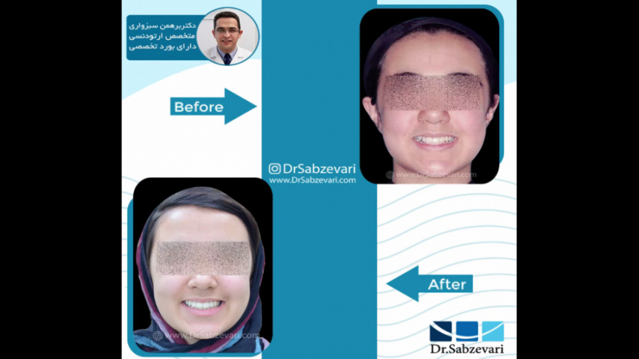 درمان ارتودنسی ثابت فک بالا و پایین بدون کشیدن دندان دکتر برهمن سبزواری - متخصص ارتودنسی - مشهد