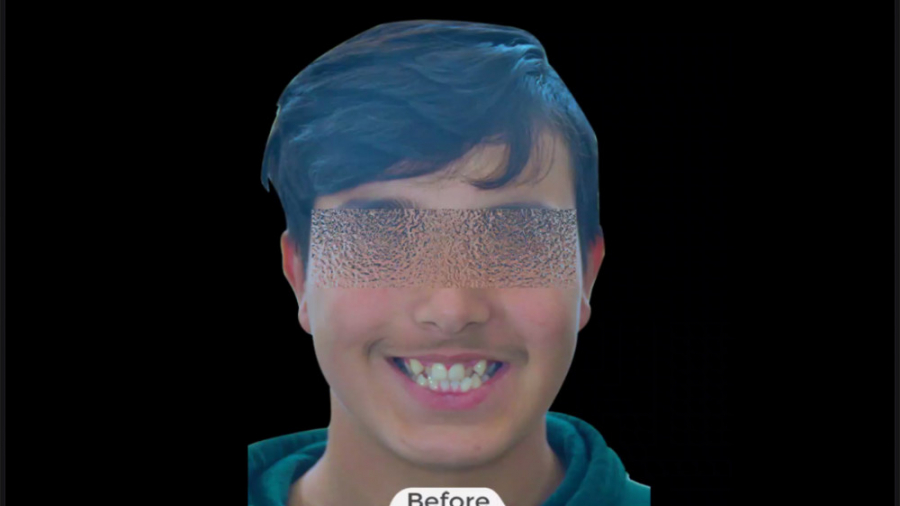 درمان ارتودنسی ثابت فک بالا و پایین بدون کشیدن دندان دایمی برای پسر نوجوان دکتر برهمن سبزواری - متخصص ارتودنسی - مشهد