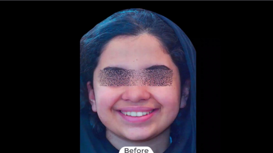 درمان ارتودنسی ثابت فک بالا و پایین بدون کشیدن دندان دایمی برای دختر خانم نوجوان دکتر برهمن سبزواری - متخصص ارتودنسی - مشهد