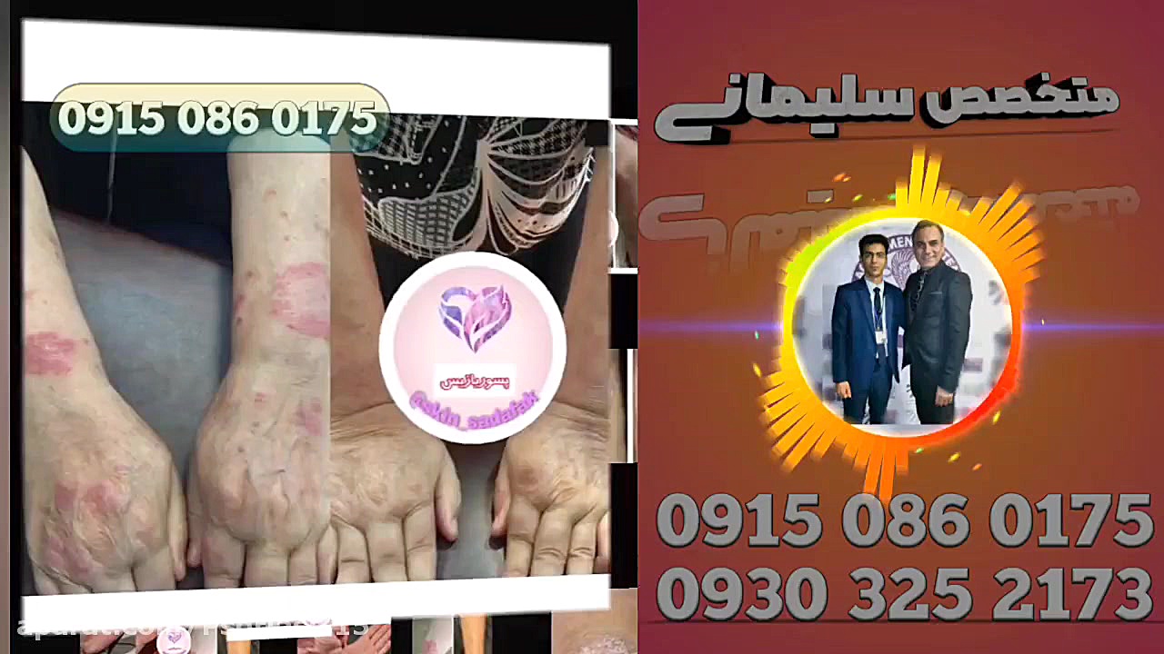 درمان پسوریازیس دکتر روازاده فیل فندقی